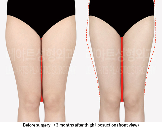 thigh_liposuction_02_02_240812