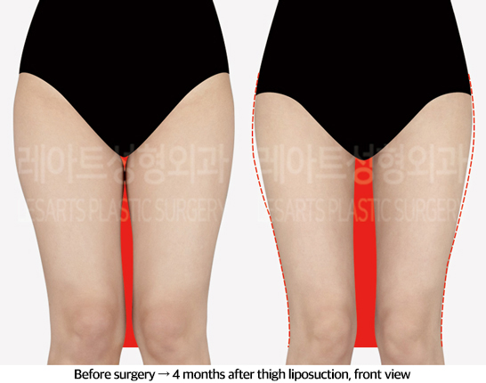 thigh_liposuction_02_02_240829