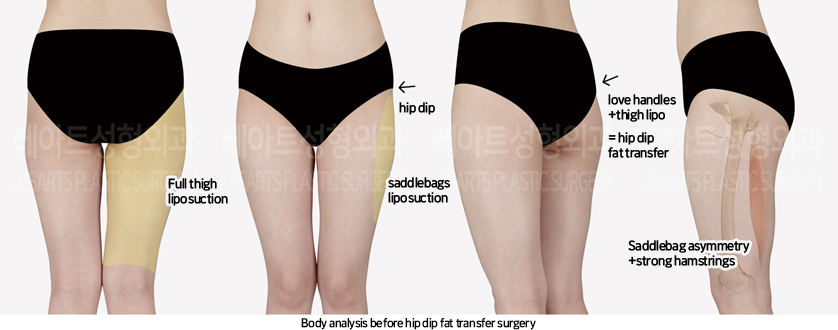 thigh_liposuction_02_02_240822