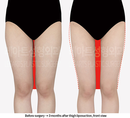 thigh_liposuction_02_02_240906