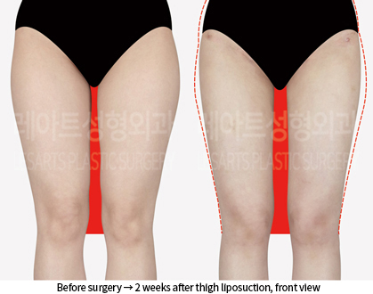 thigh_liposuction_02_02_240909