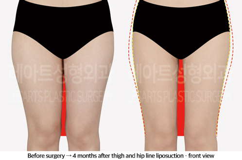 thigh_liposuction_02_02_240923