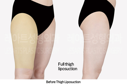thigh_liposuction_02_02_240930