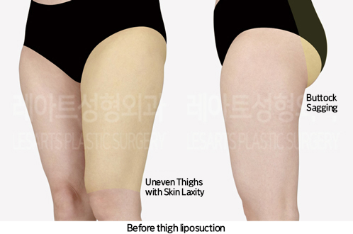 thigh_liposuction_02_02_241007