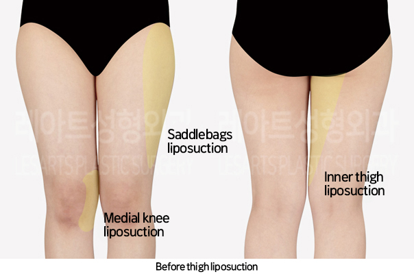 thigh_liposuction_02_02_241025