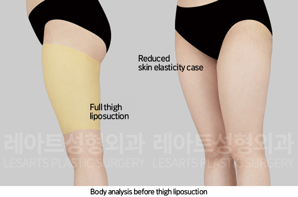 thigh_liposuction_02_02_241108