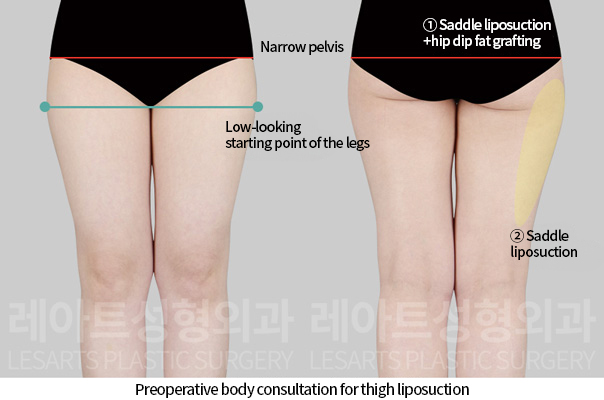 thigh_liposuction_02_02_241118