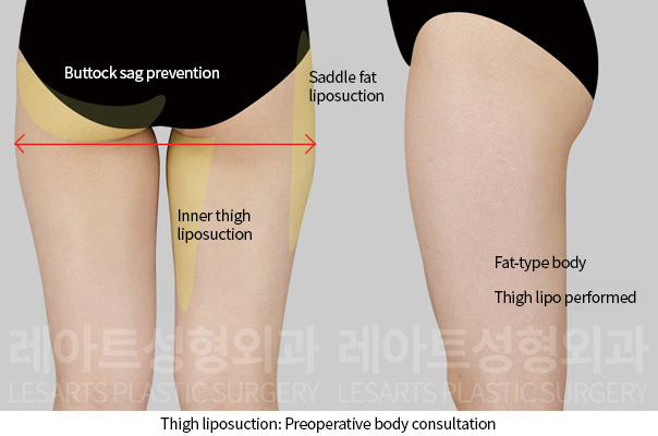 thigh_liposuction_02_02_241211