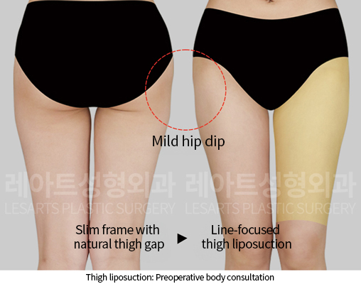 thigh_liposuction_02_02_241218