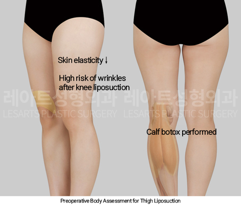 thigh_liposuction_02_02_250114