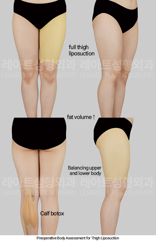 thigh_liposuction_02_02_250124