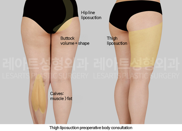 thigh_liposuction_02_02_250211
