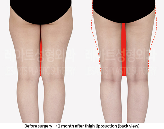 thigh_liposuction_02_03_240807