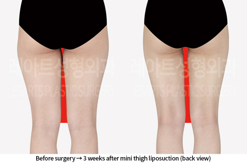 thigh_liposuction_02_03_240809