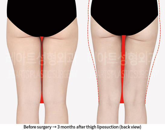 thigh_liposuction_02_03_240812