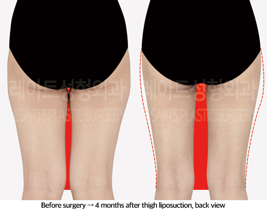 thigh_liposuction_02_03_240829