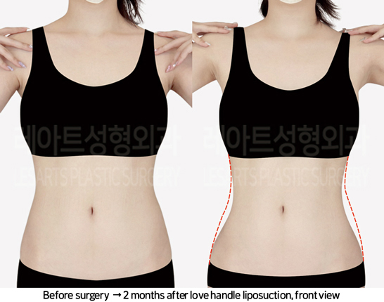 thigh_liposuction_02_03_240822