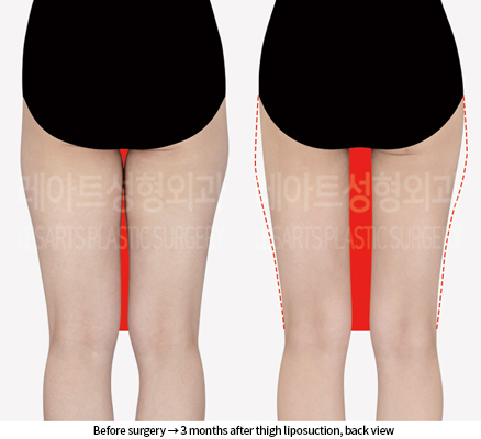 thigh_liposuction_02_03_240906
