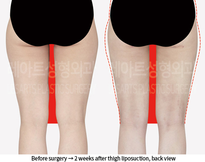 thigh_liposuction_02_03_240909