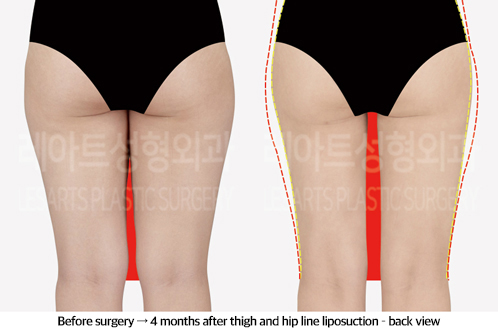 thigh_liposuction_02_03_240923