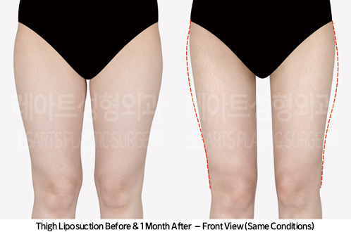 thigh_liposuction_02_03_240930