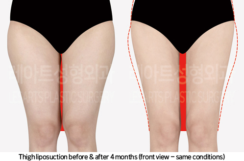 thigh_liposuction_02_03_241007
