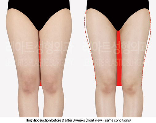 thigh_liposuction_02_03_241025