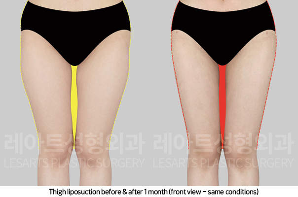 thigh_liposuction_02_03_241108