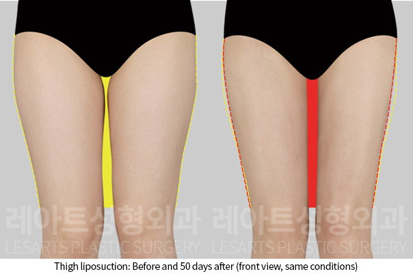 thigh_liposuction_02_03_241211