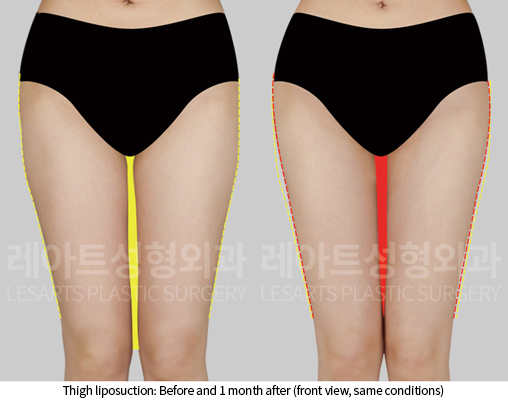 thigh_liposuction_02_03_241218