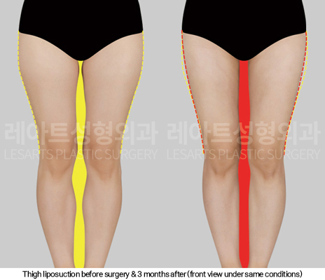 thigh_liposuction_02_03_250114