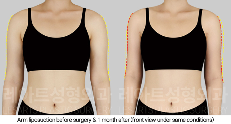 thigh_liposuction_02_03_250124