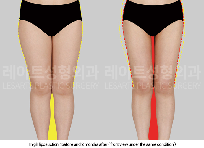 thigh_liposuction_02_03_250211