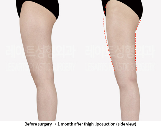 thigh_liposuction_02_04_240807