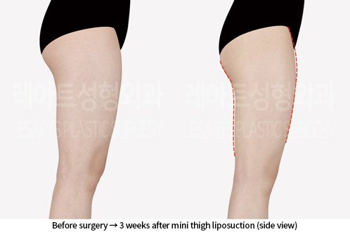 thigh_liposuction_02_04_240809