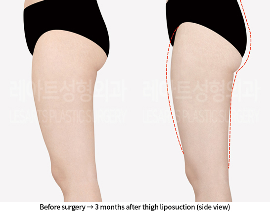 thigh_liposuction_02_04_240812