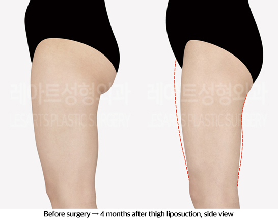thigh_liposuction_02_04_240829