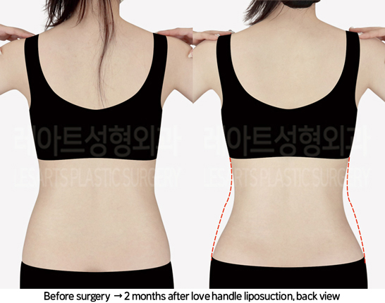 thigh_liposuction_02_04_240822