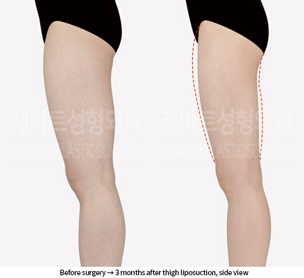 thigh_liposuction_02_04_240906