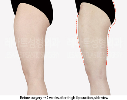 thigh_liposuction_02_04_240909