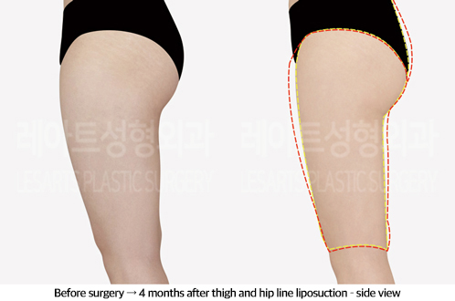 thigh_liposuction_02_04_240923