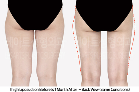 thigh_liposuction_02_04_240930