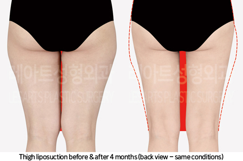 thigh_liposuction_02_04_241007