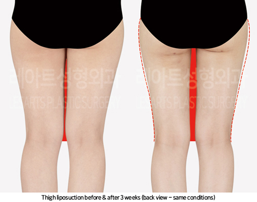 thigh_liposuction_02_04_241025
