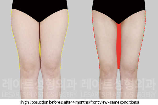 thigh_liposuction_02_04_241118