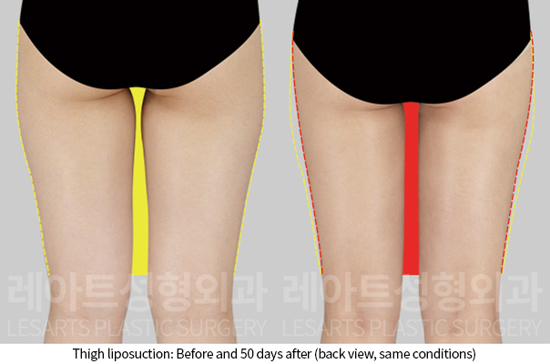 thigh_liposuction_02_04_241211