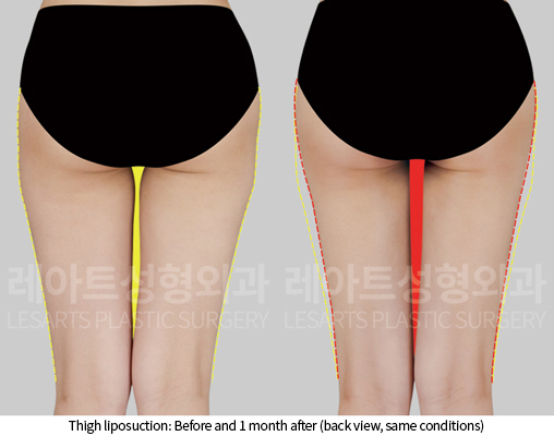 thigh_liposuction_02_04_241218