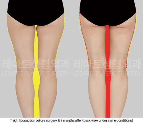 thigh_liposuction_02_04_250114