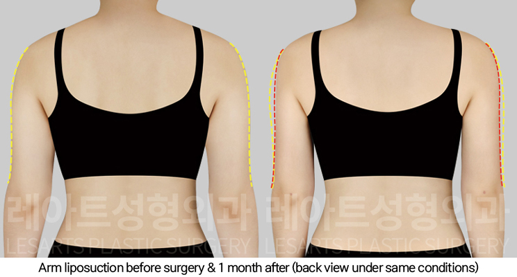 thigh_liposuction_02_04_250124