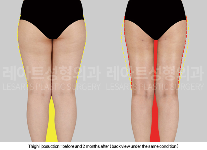 thigh_liposuction_02_04_250211